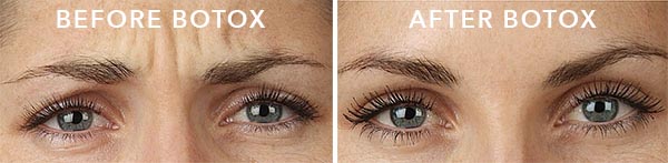 Visibly smoother - Before & After Botox Injections