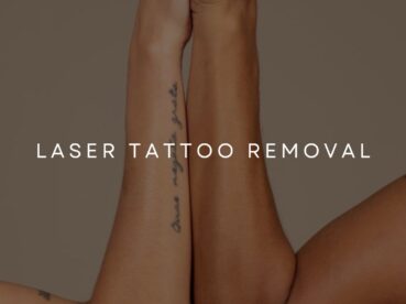 Laser Tattoo Removal