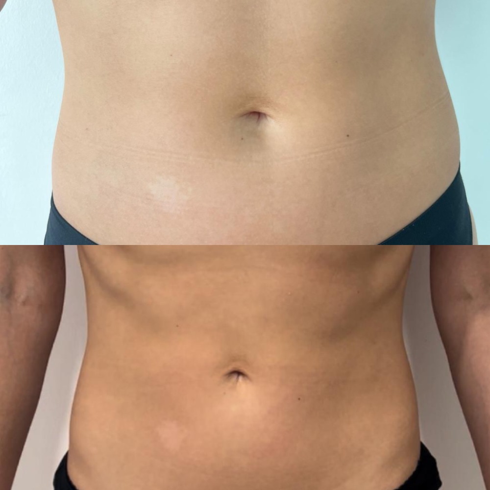 CELLUSCULPT BODY CONTOURING