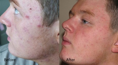 Acne before and after Dermalux