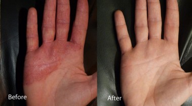 Atopic dermatitis on hands before and after Dermalux