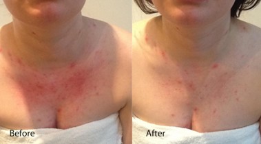 Eczema before and after Dermalux