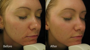 Acne and smoother skin before and after Dermalux