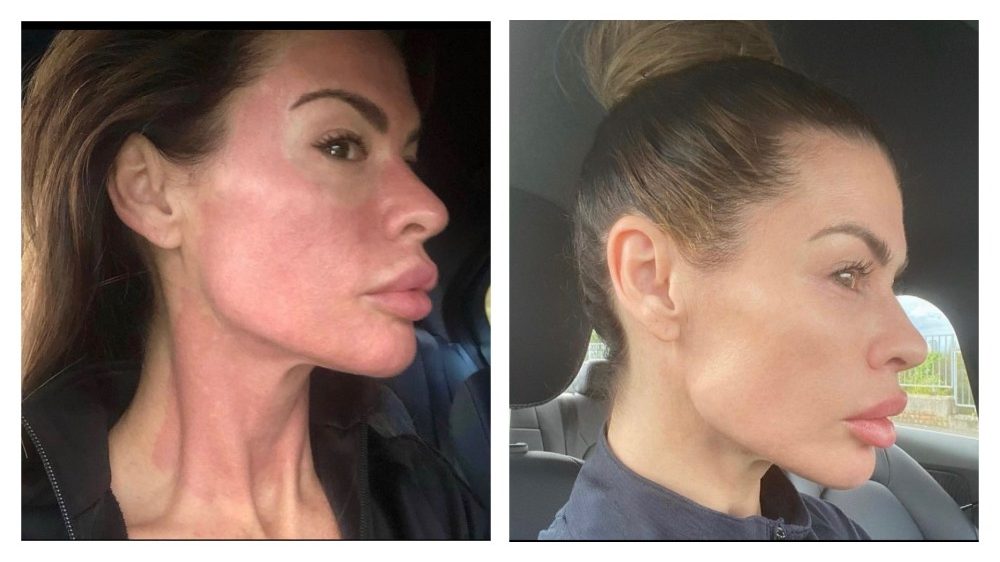 Laser Aesthetics: pixel laser resurfacing