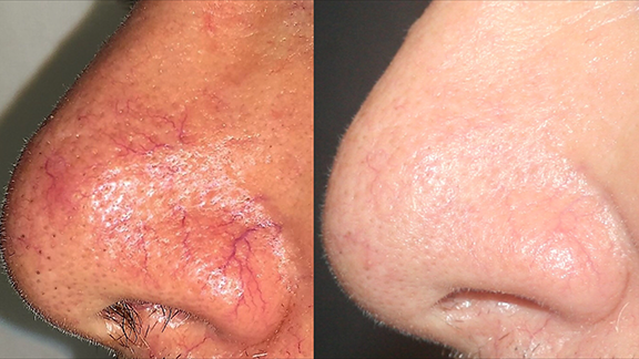 Laser Aesthetics: redness & pigmentation laser