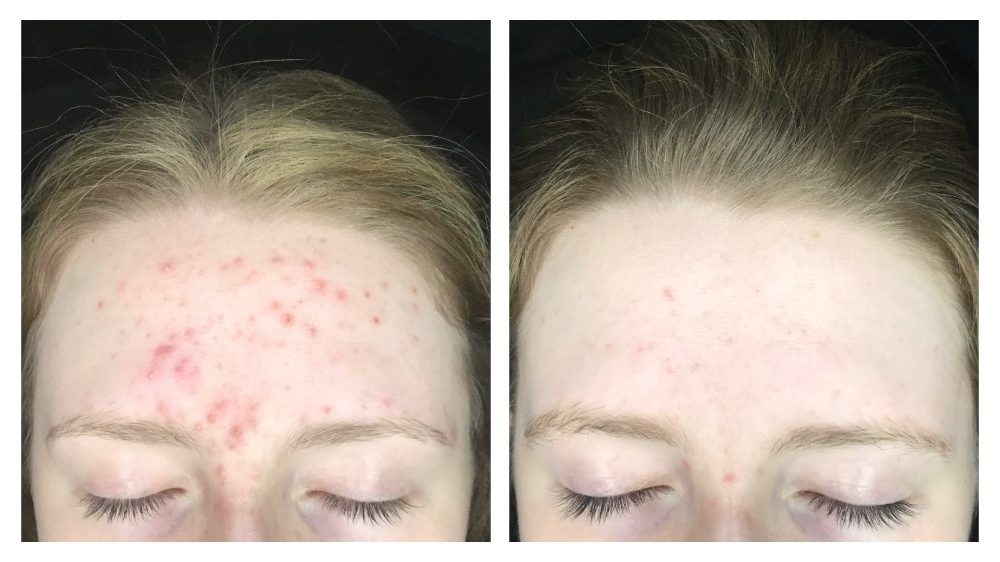 Laser Aesthetics: clearskin laser