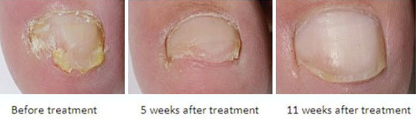 Laser Nail Fungal Treatment results 1