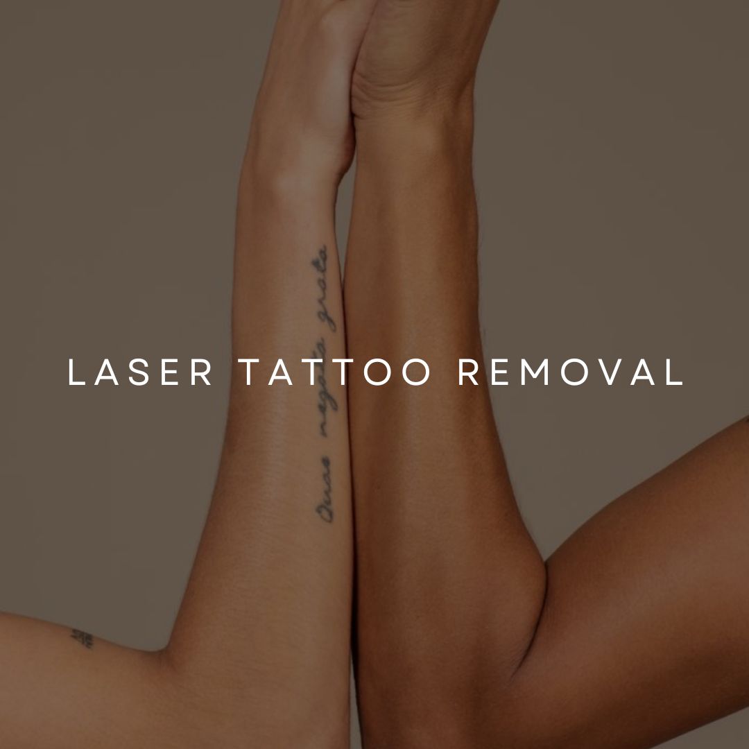 Laser Tattoo Removal