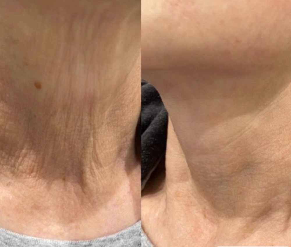 Profhilo before and after: neck