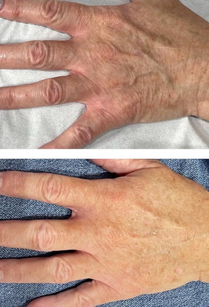Profhilo before and after: hands