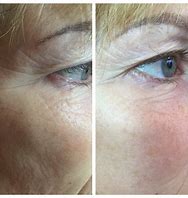Profhilo before and after: eyes