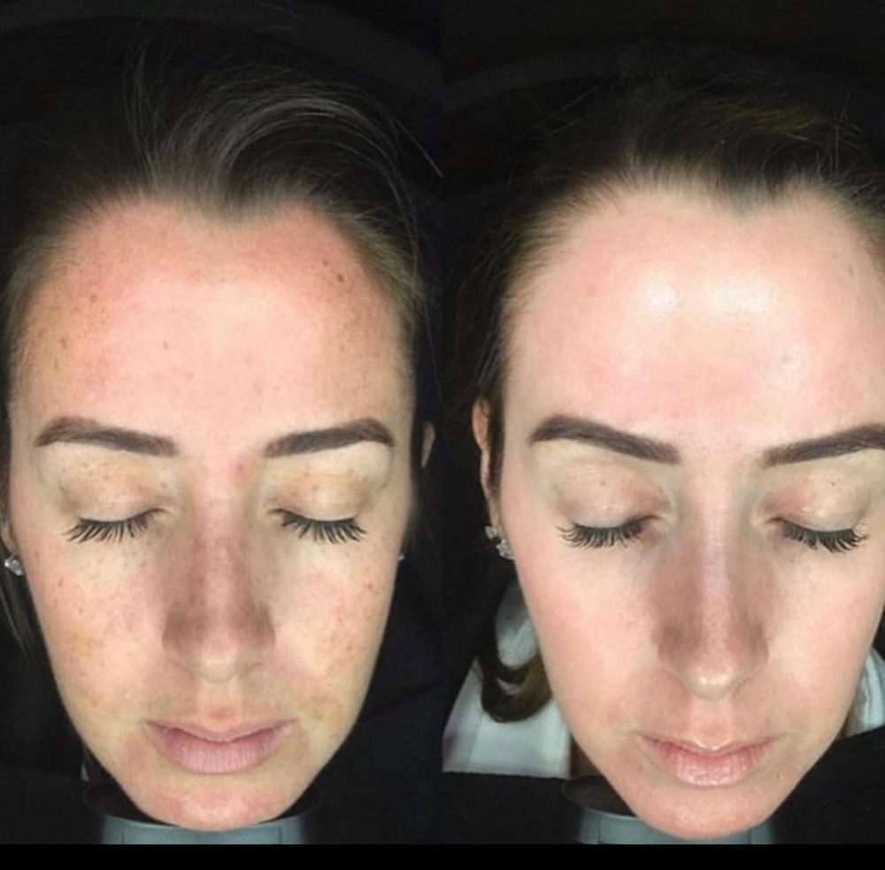 Melasma peel before and after 1