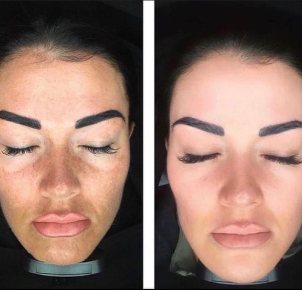 Melasma peel before and after 2