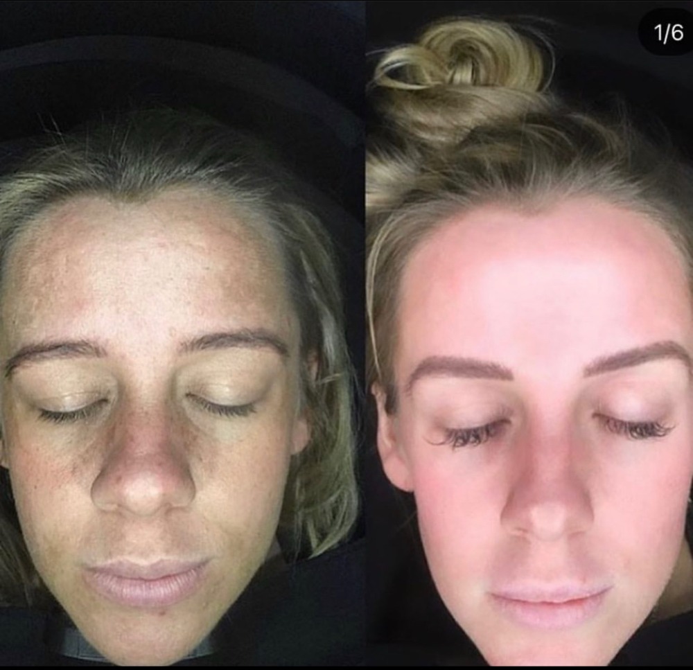 Melasma peel before and after 3