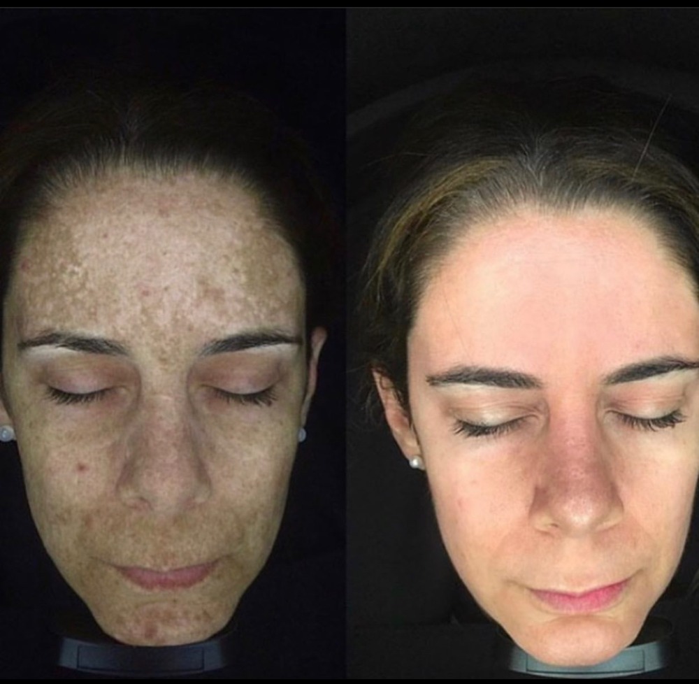 Melasma peel before and after 4