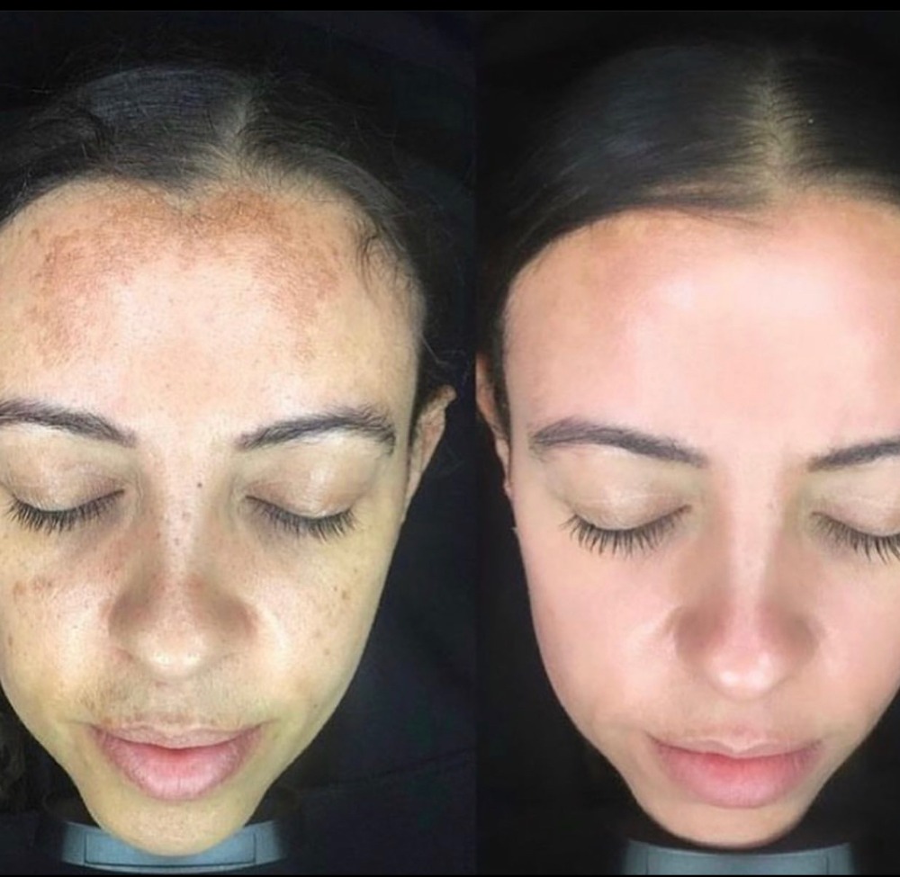 Melasma peel before and after 5